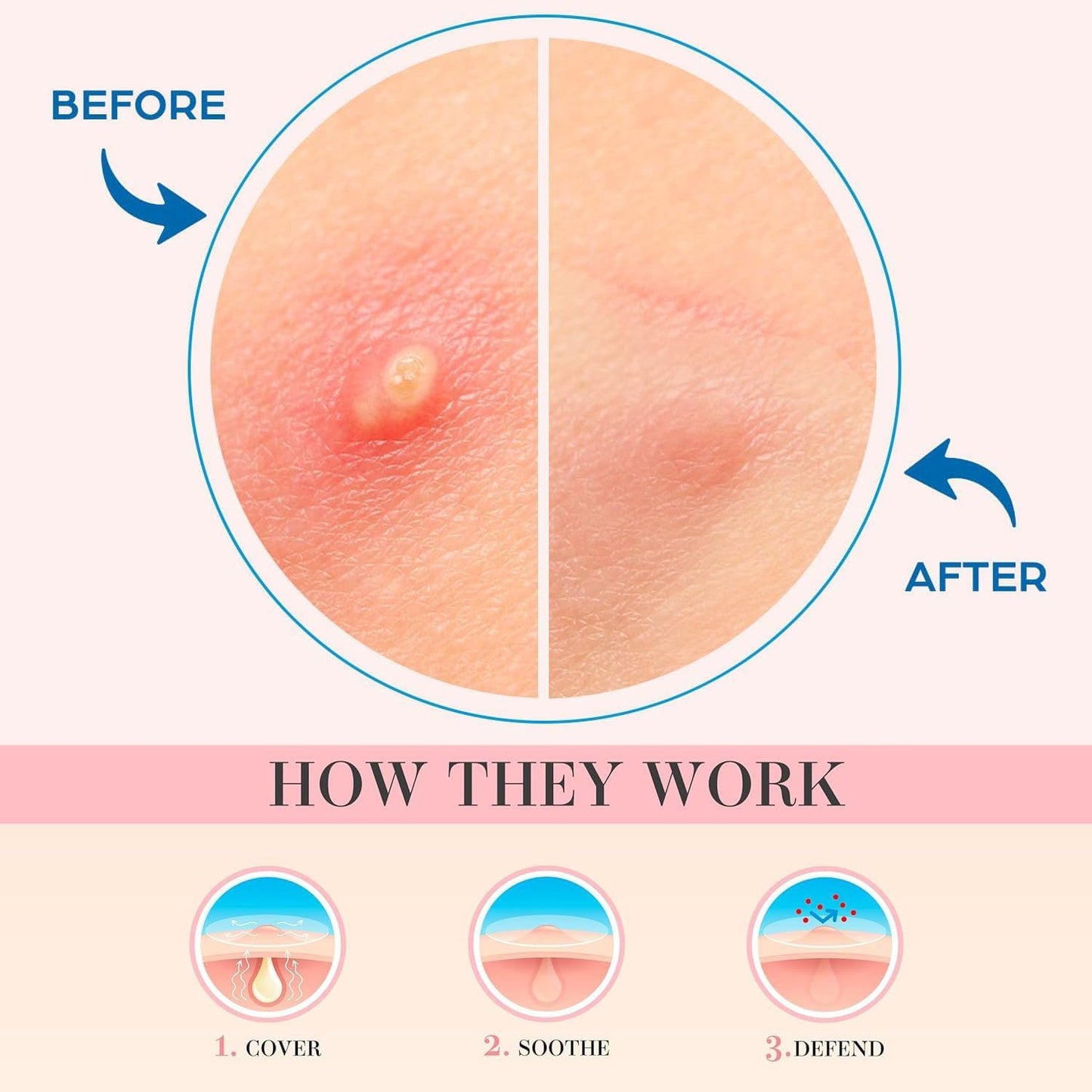 Pimple Patches For Face: Emergency Spot Patch Hydrocolloid Acne Pimple Patch for Covering Zits and Blemishes Spot Stickers for Face and Skin 36 Patches