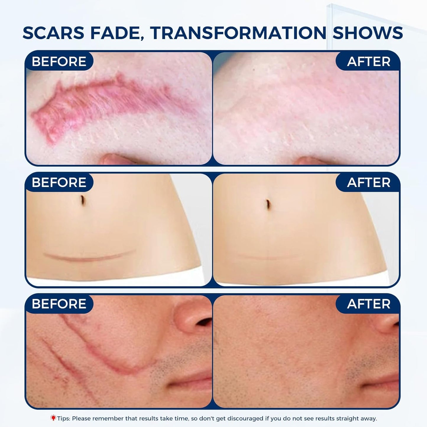 Silicone Scar Gel - 100% Silicone Cream Perfect for Sensitive Skin, Say Goodbye to Old and New Scars (30ml)