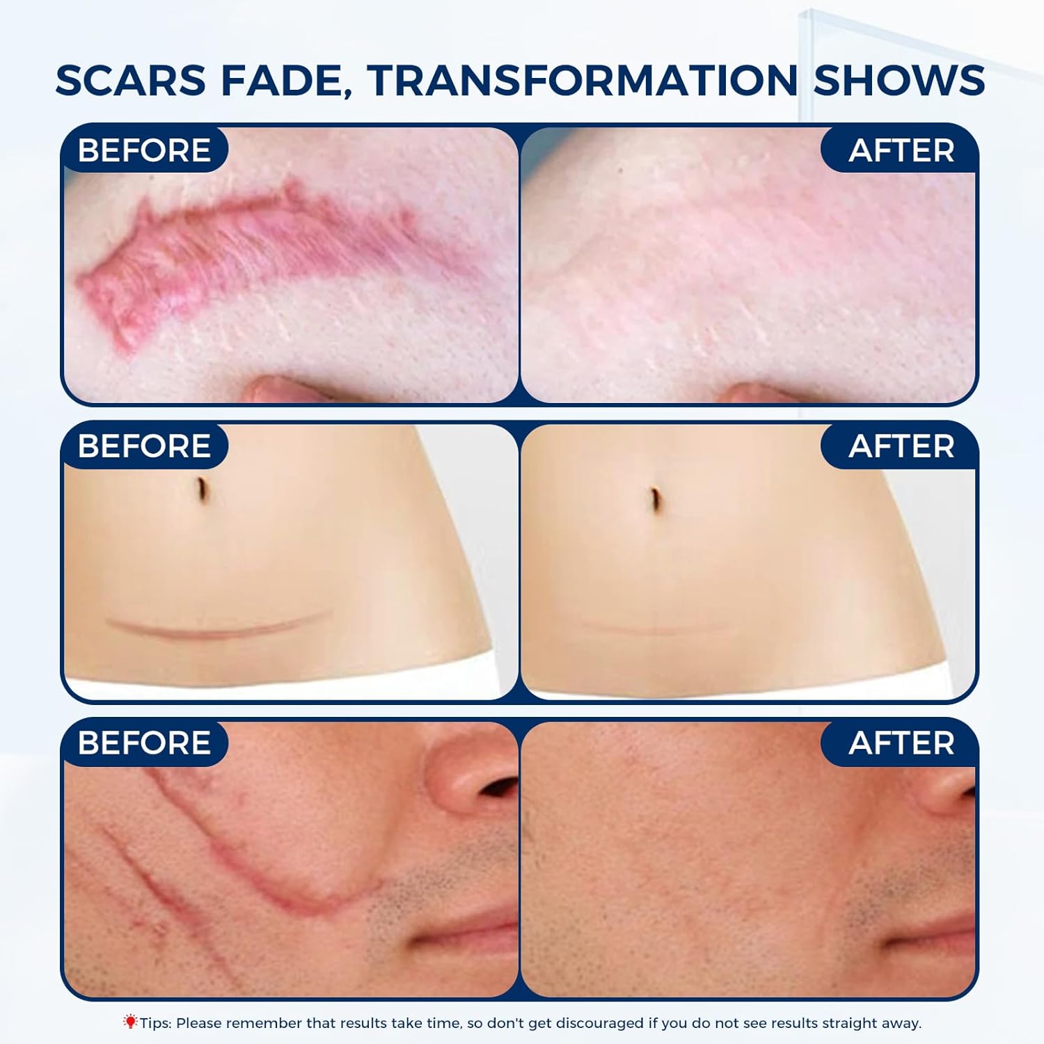 Silicone Scar Gel - 100% Silicone Cream Perfect for Sensitive Skin, Say Goodbye to Old and New Scars (30ml)