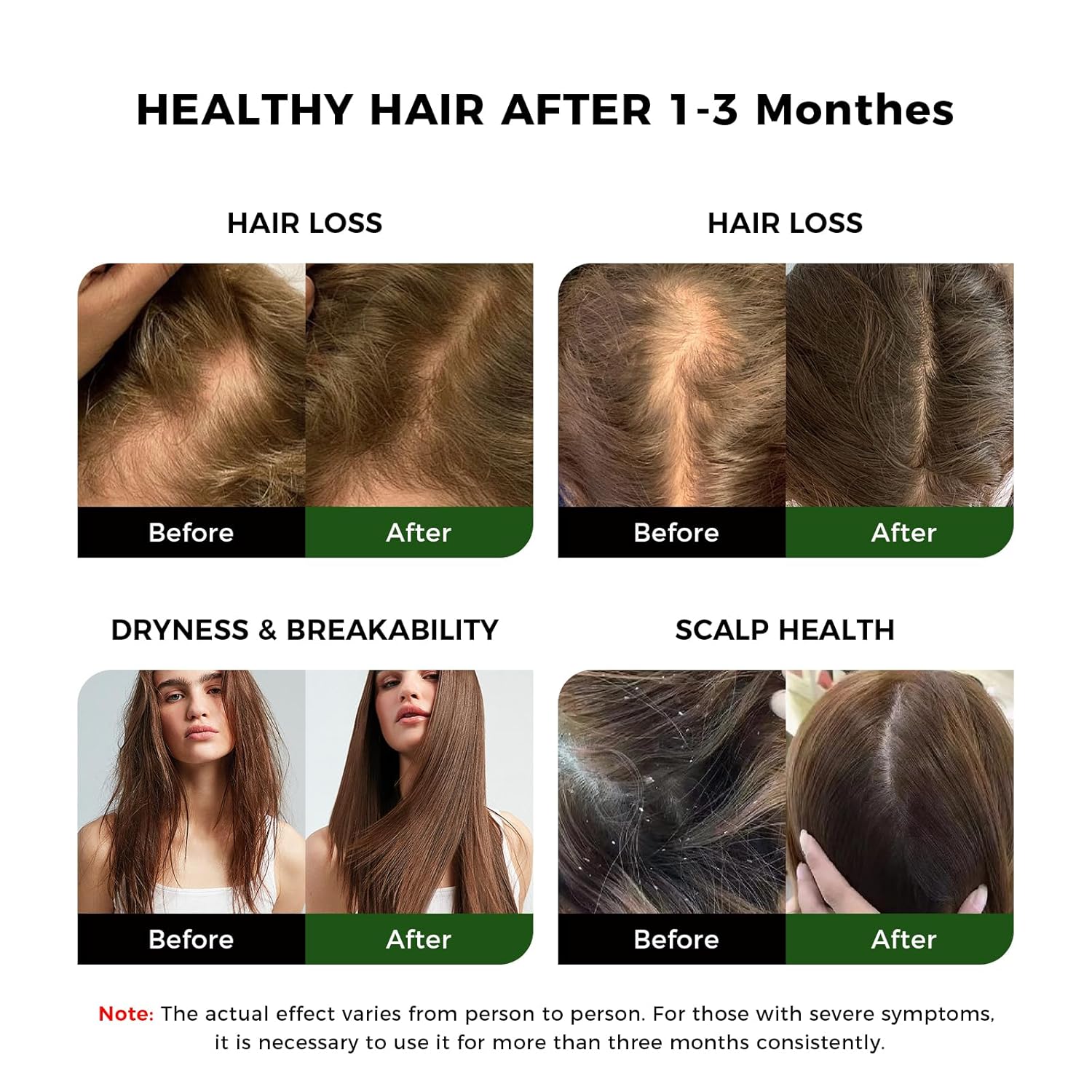 Raw Batana Oil for Hair Growth, 100% Natural Pure Dr. Sebi Batana Oil from Honduras, Organic Batana Oil Hair Growth Oil for Prevent Hair Loss, Enhances Hair Thickness, for Men &amp; Women 5.3 oz