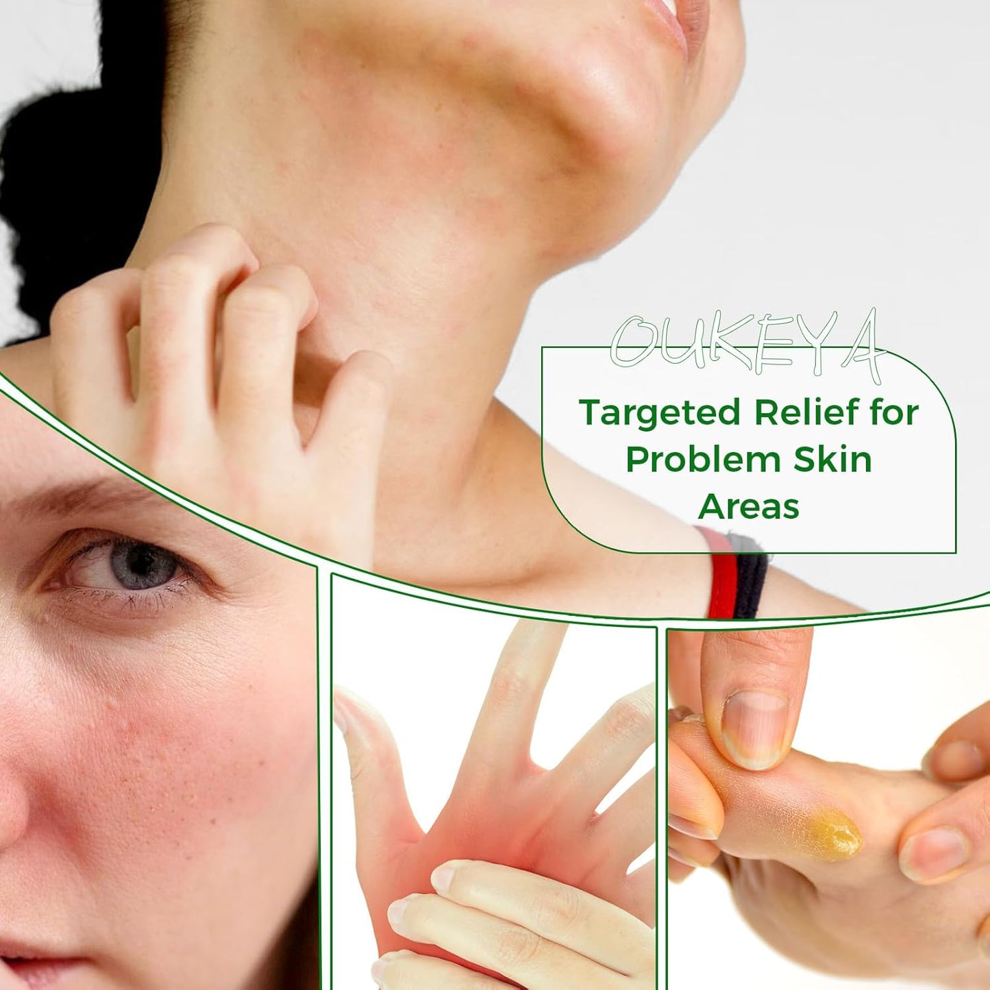 Tea Tree Oil Balm All Natural Tea Tree Balm Soothe Skin Discomfort And Moisturize Dry Skin On Hands, Feet, And Body, Acne, Eczema &amp; Psoriasis Relief 2.82 oz