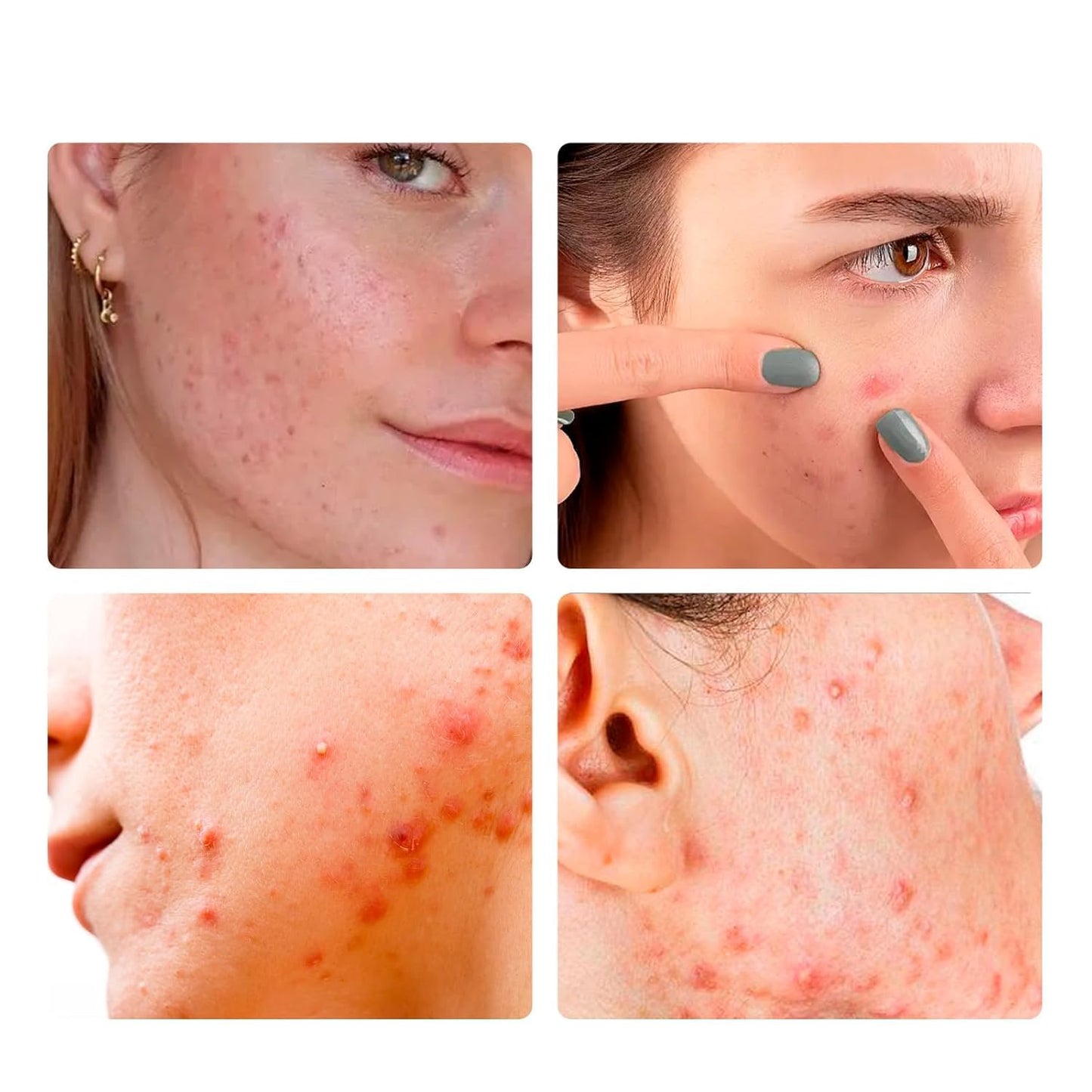 Pimple Patches For Face: Emergency Spot Patch Hydrocolloid Acne Pimple Patch for Covering Zits and Blemishes Spot Stickers for Face and Skin 36 Patches