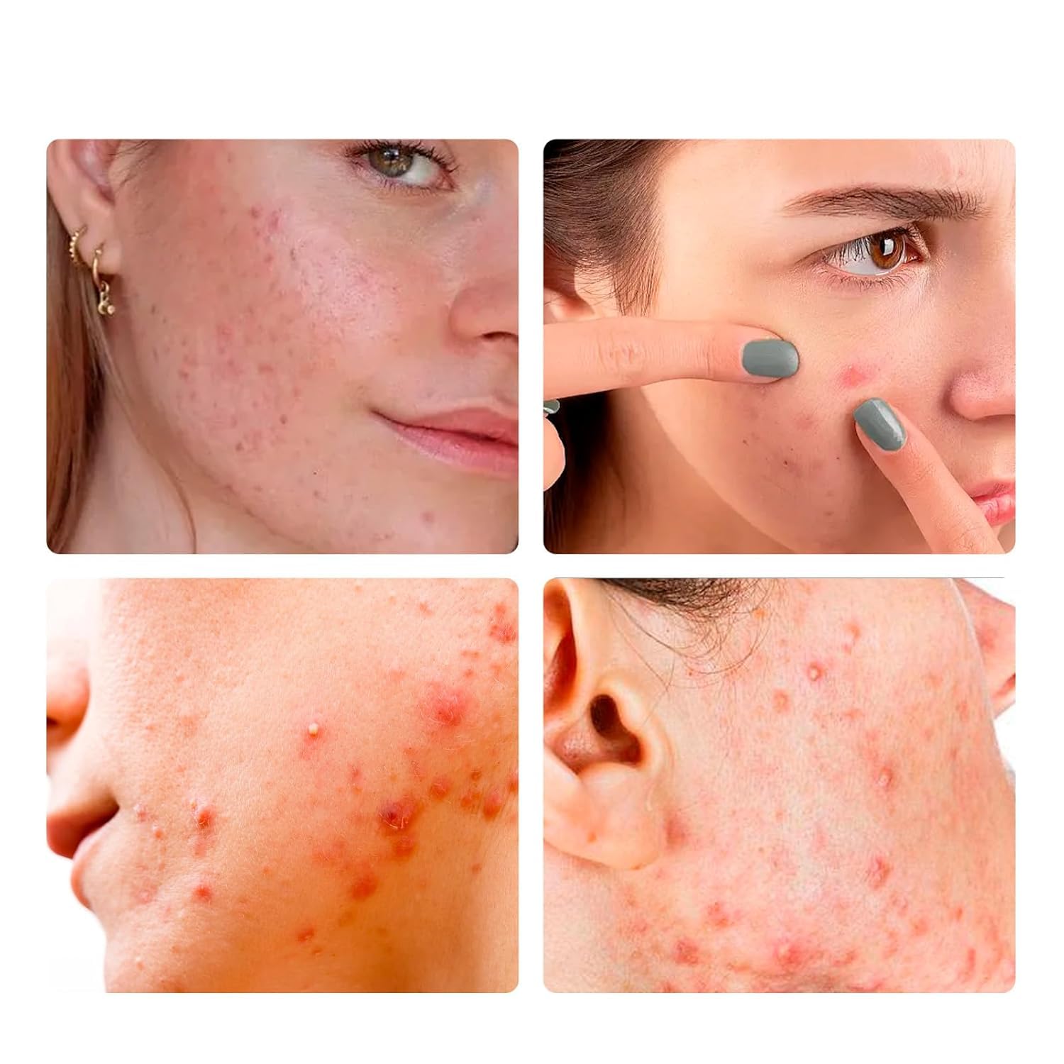 Pimple Patches For Face: Emergency Spot Patch Hydrocolloid Acne Pimple Patch for Covering Zits and Blemishes Spot Stickers for Face and Skin 36 Patches