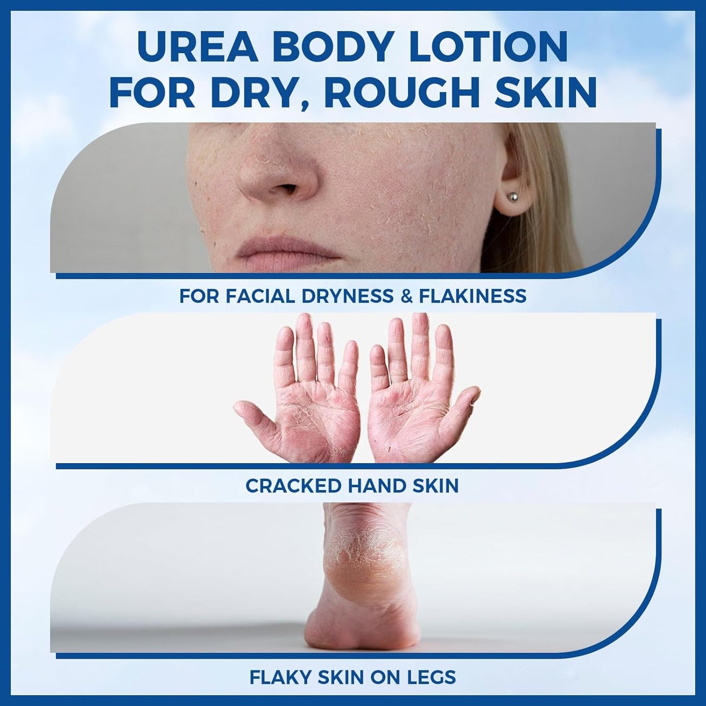 10% Urea Body Lotion, 11.28 oz Skin Moisturizer Softens &amp; Soothes Dry Chapped Skin, Hands Elbows Feet Body Lotion Hydrates Locks in Moisture Non-Greasy Formula