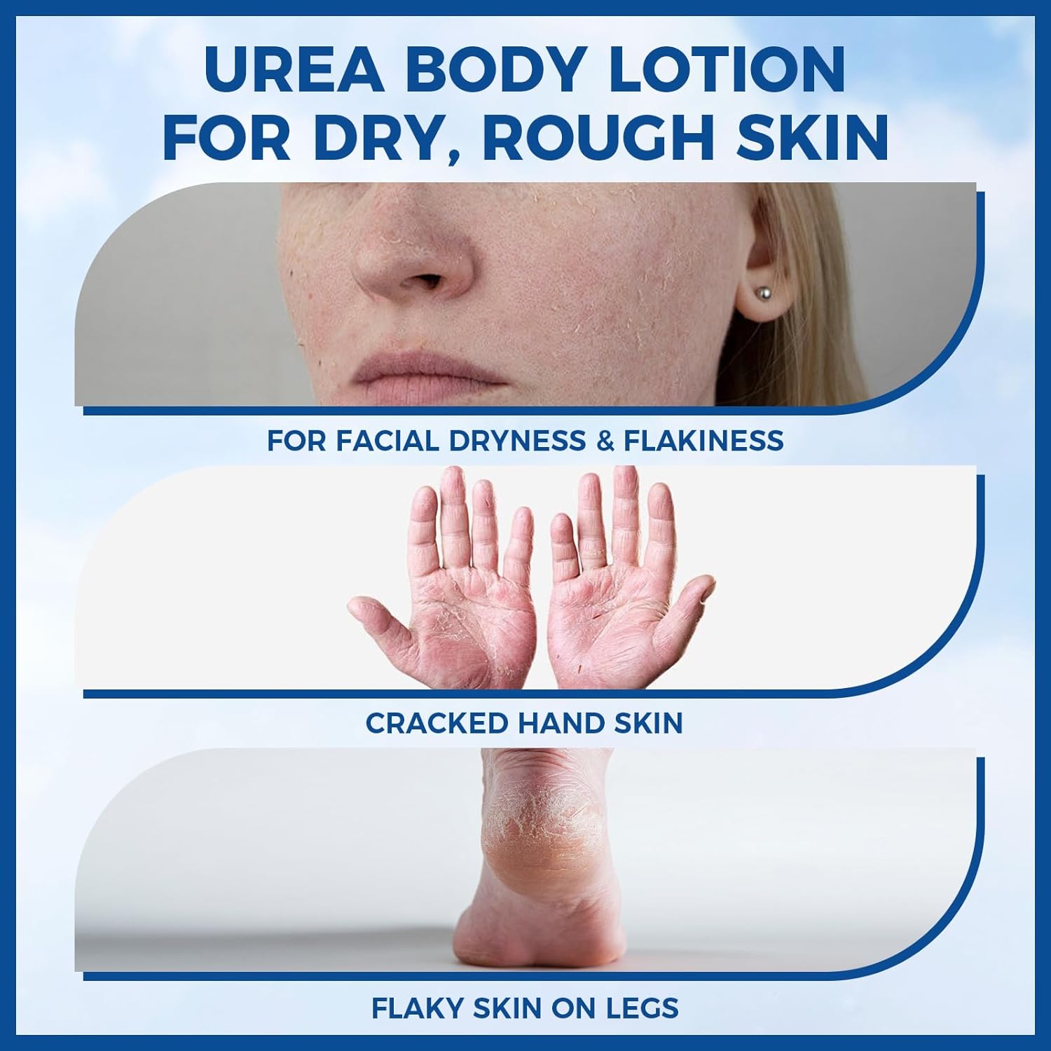 10% Urea Body Lotion, 11.28 oz Skin Moisturizer Softens &amp; Soothes Dry Chapped Skin, Hands Elbows Feet Body Lotion Hydrates Locks in Moisture Non-Greasy Formula