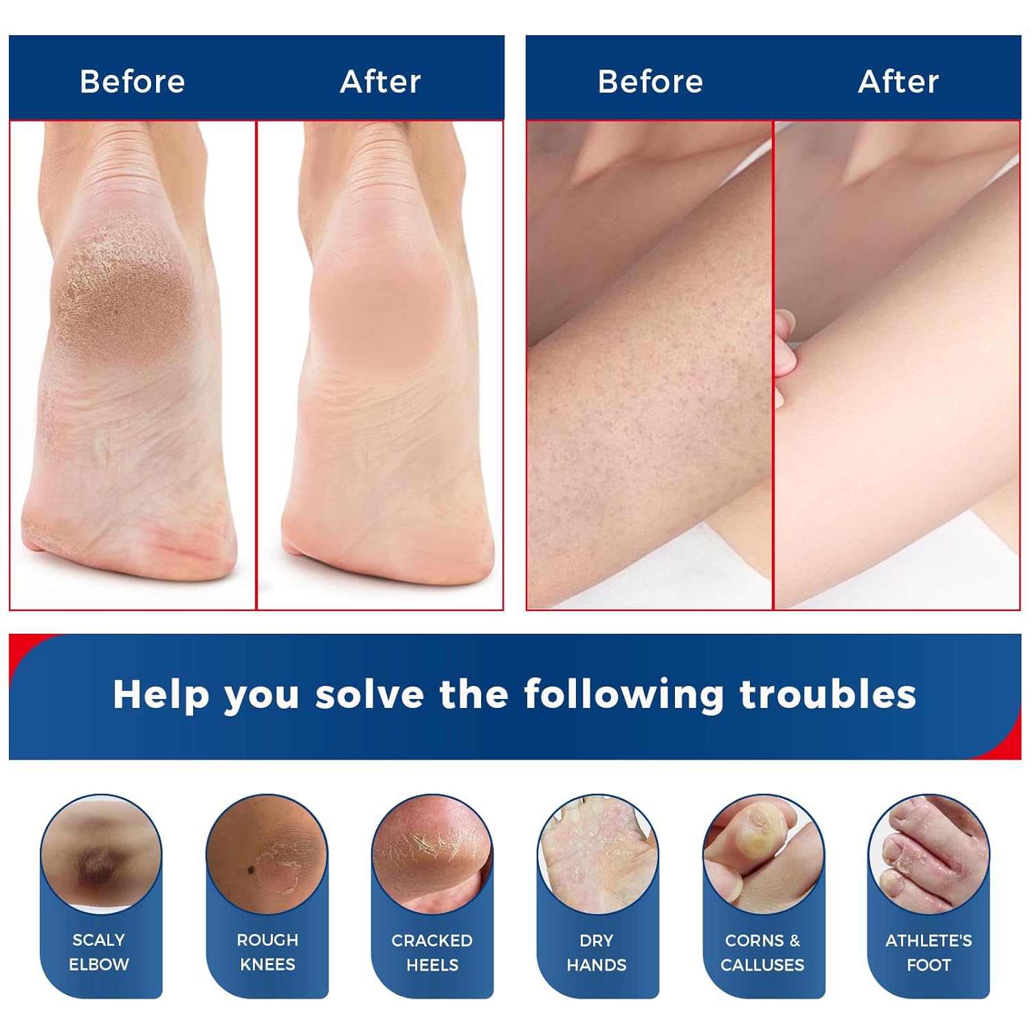 NEW FORMULA Urea Cream 40% Plus 2% Salicylic Acid for Feet Maximum Strength, Dry Cracked Hand Heel Moisturizing Repair Lotion for Knees, Elbows, Removes Corns, Dead Skin Cream, 5.29 oz